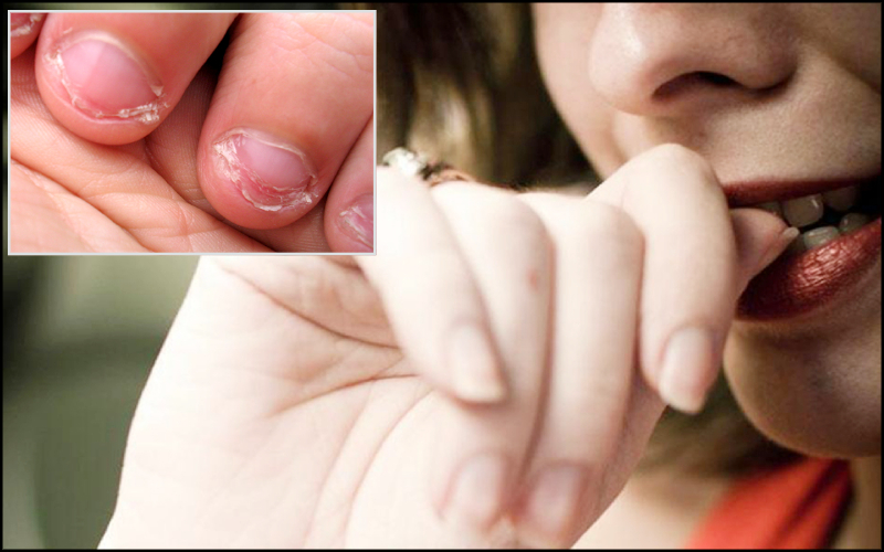 Biting Your Nails : గోళ్లు కొరికే అలవాటు ఉందా? ఈ జబ్బుల ముప్పు ఎక్కువ