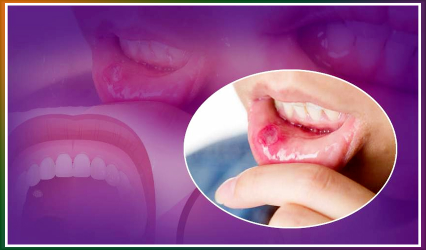 how to cure mouth ulcers fast naturally