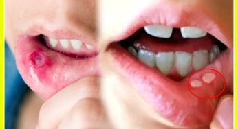 Mouth Ulcers : నోటిపూత బాధిస్తోందా ? ఈ అద్భుతమైన రెమిడీలతో ఇలా చెక్ పెట్టండి..