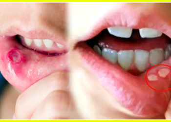 Mouth-Ulcers-Fast-Naturally