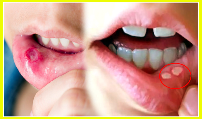 Mouth-Ulcers-Fast-Naturally