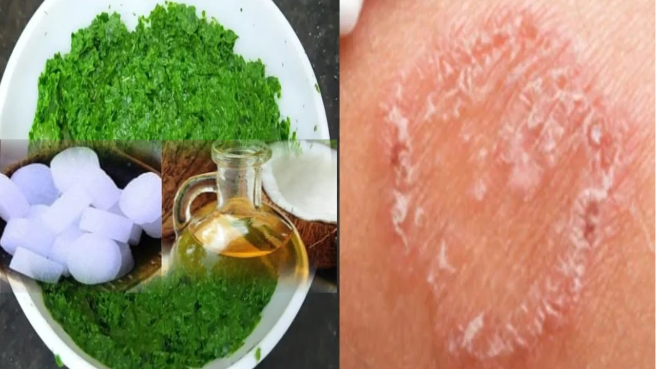 ringworm home remedy for humans in telugu