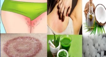 Ringworm Home Remedies : గజ్జి, తామరతో బాధపడుతున్నారా..? ఆయుర్వేదంలోని ఈ అద్భుతమైన రెమిడీని ఇంట్లోనే తయారు చేసుకోండి..!