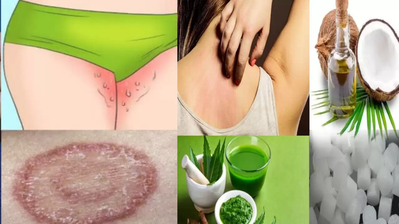 Ringworm Home Remedies in telugu 9 Ways to Treat Symptoms
