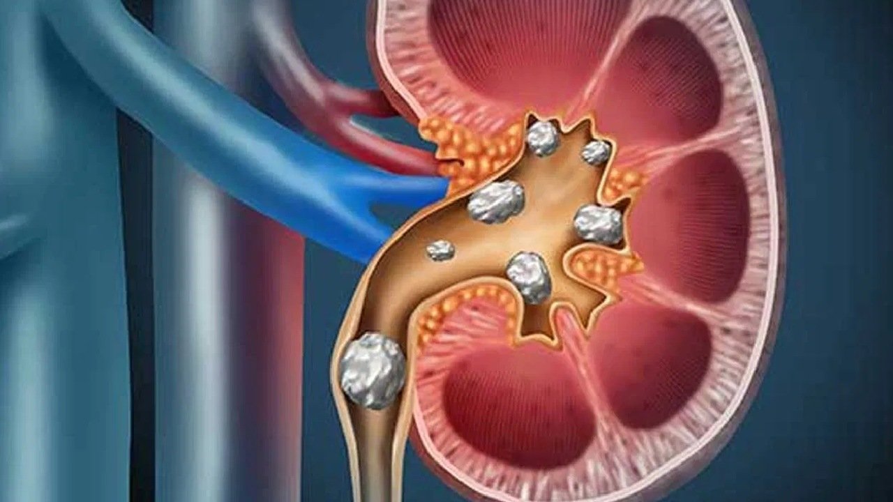 home remedy for kidney stones in telugu